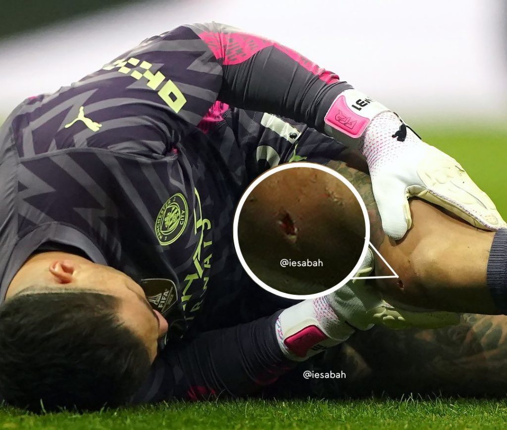 can canh chan thuong ghe ron cua thu mon ederson truoc newcastle