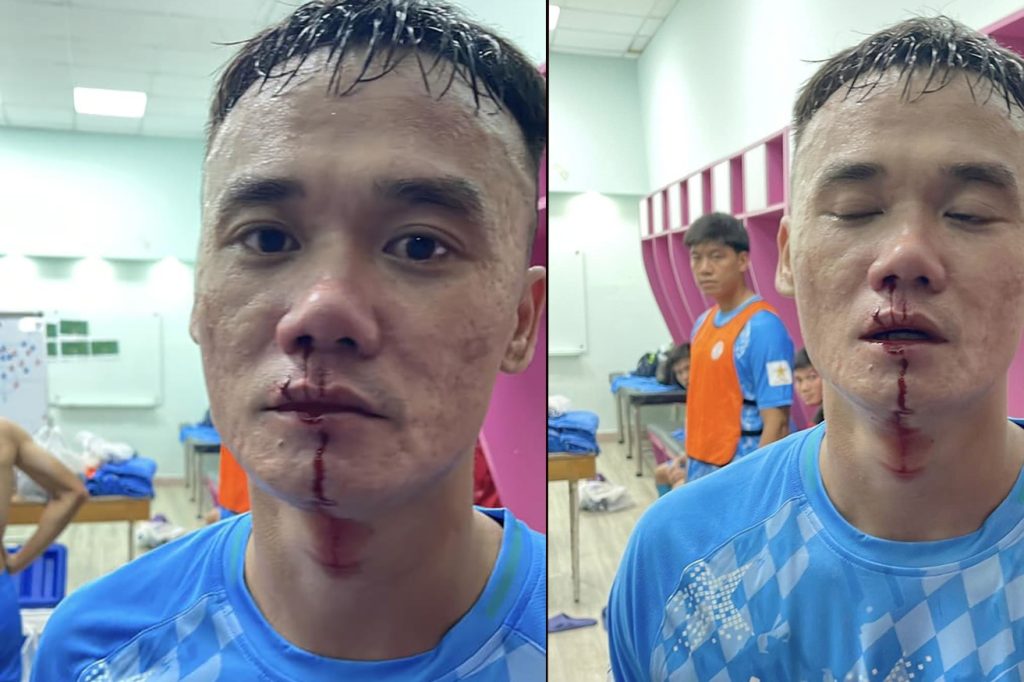 tro cu hlv park hang seo bi cau thu doi phuong dam vo mui 91169